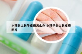 小孩头上长牛皮癣怎么办 小孩子头上长皮癣图片