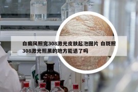 白癜风照完308激光皮肤起泡图片 白斑照308激光照黑的地方能退了吗