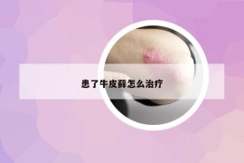 患了牛皮藓怎么治疗