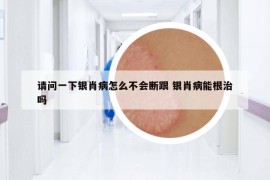 请问一下银肖病怎么不会断跟 银肖病能根治吗