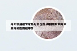 绵阳银屑病专家最好的医院 绵阳银屑病专家最好的医院在哪里