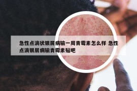 急性点滴状银屑病输一周青霉素怎么样 急性点滴银屑病输青霉素贴吧