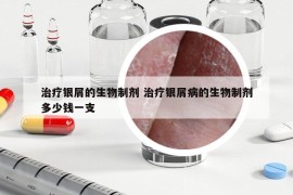 治疗银屑的生物制剂 治疗银屑病的生物制剂多少钱一支