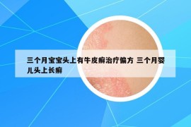 三个月宝宝头上有牛皮癣治疗偏方 三个月婴儿头上长癣