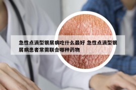 急性点滴型银屑病吃什么最好 急性点滴型银屑病患者常需联合哪种药物