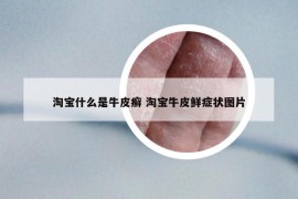 淘宝什么是牛皮癣 淘宝牛皮鲜症状图片