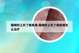 胳膊肘上长了银屑病 胳膊肘上长了银屑病怎么治疗