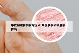 牛皮癣跟粉刺有啥区别 牛皮肤癣和银屑病一样吗