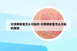 红斑鳞屑是怎么引起的 红斑鳞屑是怎么引起的原因