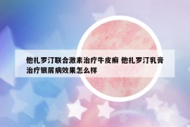 他扎罗汀联合激素治疗牛皮癣 他扎罗汀乳膏治疗银屑病效果怎么样