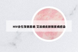 HIV会引发银屑病 艾滋病皮肤银屑病感染