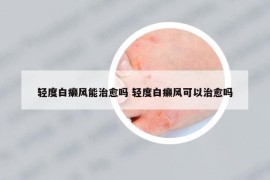 轻度白癞风能治愈吗 轻度白癞风可以治愈吗