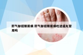 肝气郁结银屑病 肝气郁结银屑病吃逍遥丸管用吗