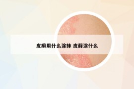 皮癣用什么涂抹 皮藓涂什么