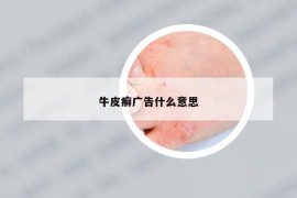 牛皮癣广告什么意思