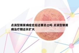 点滴型银屑病痊愈后还要忌口吗 点滴型银屑病治疗期还长扩大