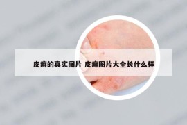 皮癣的真实图片 皮癣图片大全长什么样