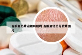 百癣夏热片治银屑病吗 百癣夏塔热分散片图片