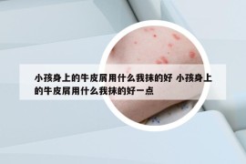 小孩身上的牛皮屑用什么我抹的好 小孩身上的牛皮屑用什么我抹的好一点