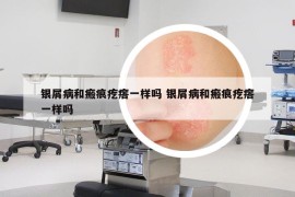 银屑病和瘢痕疙瘩一样吗 银屑病和瘢痕疙瘩一样吗