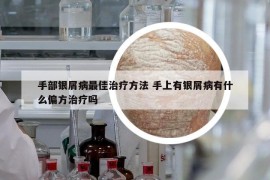 手部银屑病最佳治疗方法 手上有银屑病有什么偏方治疗吗