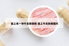 腿上有一块牛皮癣很痒 腿上牛皮肤癣图片