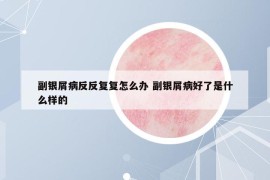 副银屑病反反复复怎么办 副银屑病好了是什么样的