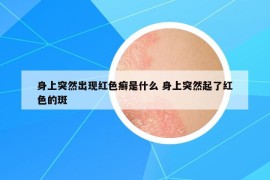 身上突然出现红色癣是什么 身上突然起了红色的斑