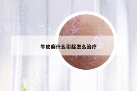 牛皮癣什么引起怎么治疗