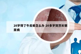 20岁得了牛皮癣怎么办 20多岁突然长银屑病