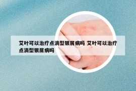 艾叶可以治疗点滴型银屑病吗 艾叶可以治疗点滴型银屑病吗