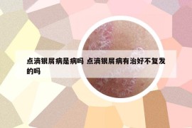 点滴银屑病是病吗 点滴银屑病有治好不复发的吗