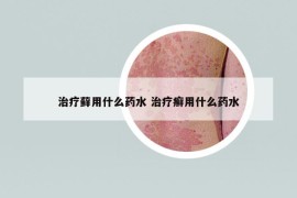 治疗藓用什么药水 治疗癣用什么药水