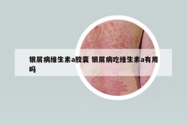 银屑病维生素a胶囊 银屑病吃维生素a有用吗