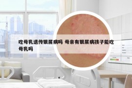 吃母乳遗传银屑病吗 母亲有银屑病孩子能吃母乳吗