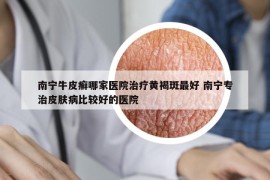 南宁牛皮癣哪家医院治疗黄褐斑最好 南宁专治皮肤病比较好的医院