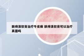 肤痔清软膏治疗牛皮癣 肤痔清软膏可以治疗真菌吗