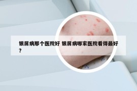 银屑病那个医院好 银屑病哪家医院看得最好?