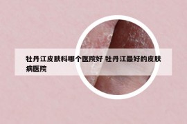 牡丹江皮肤科哪个医院好 牡丹江最好的皮肤病医院