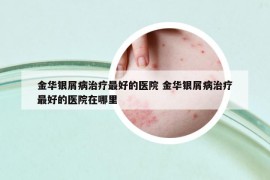 金华银屑病治疗最好的医院 金华银屑病治疗最好的医院在哪里