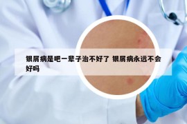 银屑病是吧一辈子治不好了 银屑病永远不会好吗