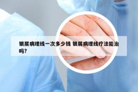 银屑病埋线一次多少钱 银屑病埋线疗法能治吗?