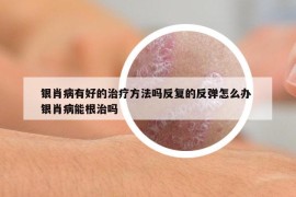 银肖病有好的治疗方法吗反复的反弹怎么办 银肖病能根治吗