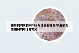 银屑病的生物制剂治疗优点有哪些 银屑病的生物制剂那个疗效好