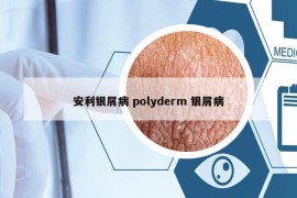 安利银屑病 polyderm 银屑病