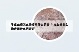 牛皮血癣怎么治疗用什么药膏 牛皮血癣怎么治疗用什么药膏好