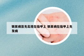 银屑病首先出现在指甲上 银屑病在指甲上先发病