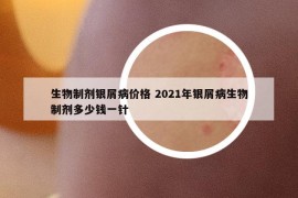 生物制剂银屑病价格 2021年银屑病生物制剂多少钱一针