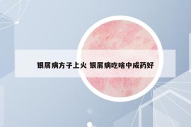 银屑病方子上火 银屑病吃啥中成药好