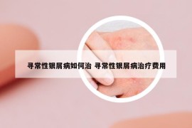 寻常性银屑病如何治 寻常性银屑病治疗费用